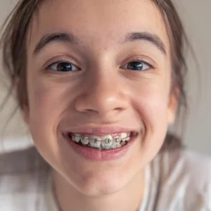 Clear Braces