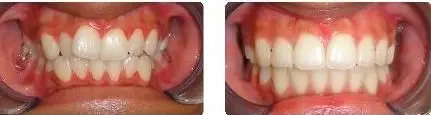 aanisah b and a teeth only1.jpg