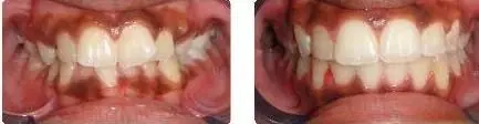 alicia before and after teeth only.jpg