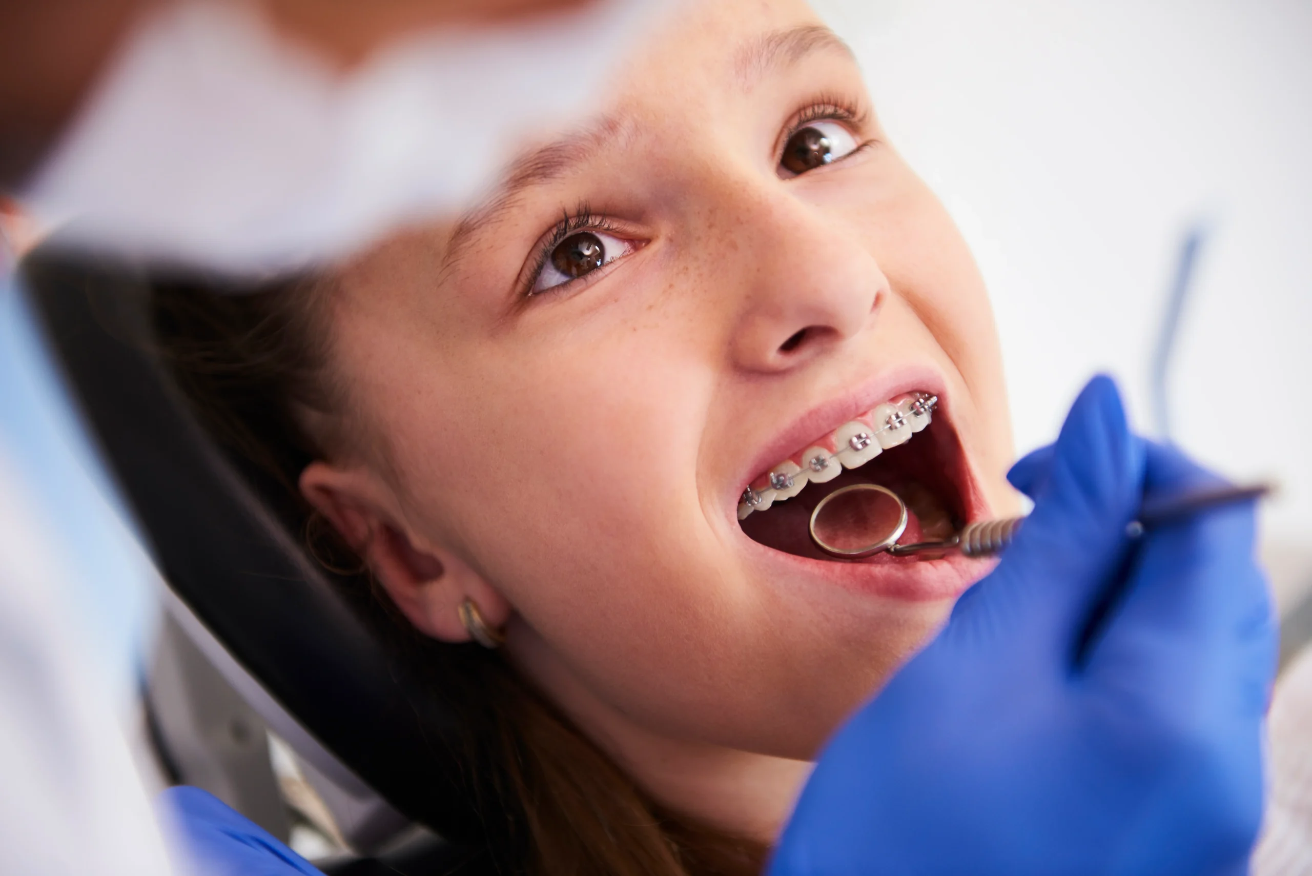 Metal Braces Treatment Speed